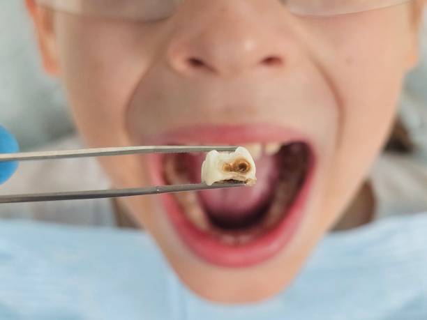 Best Emergency Treatment for Oral Infections in Olmsted Falls, OH